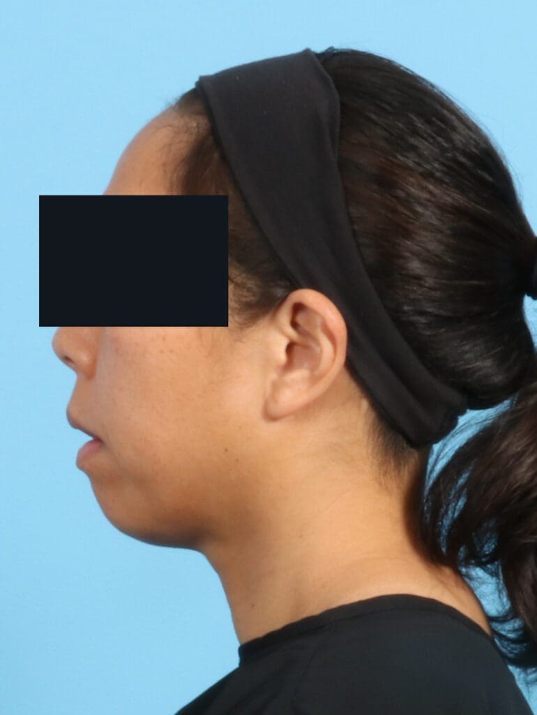 Chin Implant - Case 24220 - Before