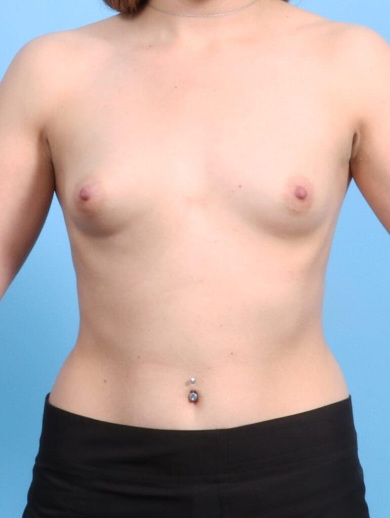 Breast Augmentation - Case 24334 - Before
