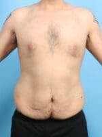 After Weight Loss - Case 24342 - Before