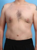 After Weight Loss - Case 24342 - After