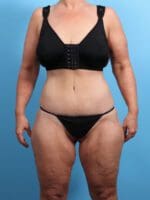 After Weight Loss - Case 24359 - After