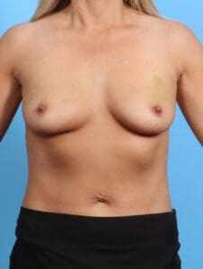 Breast Augmentation - Case 24376 - Before