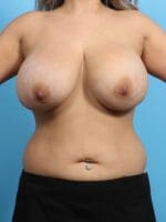 Breast Implant Revision - Case 24430 - Before