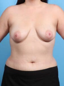 Breast Lift/Reduction with Implants - Case 24478 - Before
