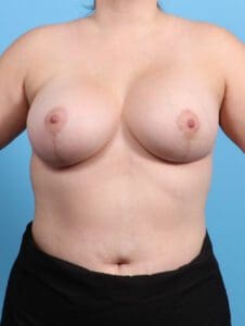 Breast Lift/Reduction with Implants - Case 24478 - After