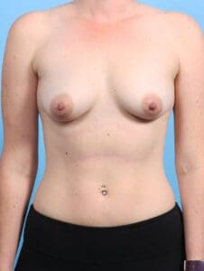 Breast Augmentation - Case 24540 - Before