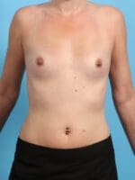 Breast Augmentation - Case 24556 - Before