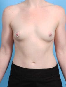 Breast Augmentation - Case 24580 - Before