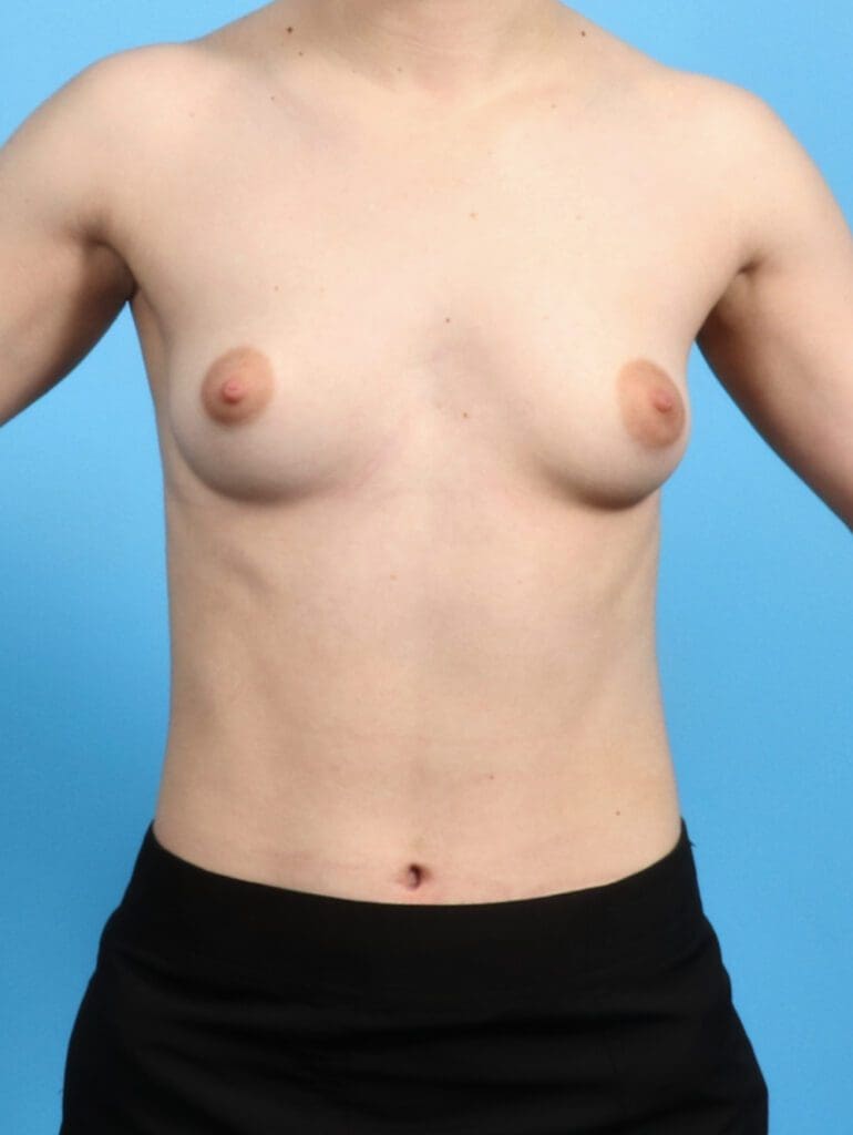 Breast Augmentation - Case 24589 - Before