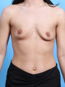Breast Augmentation - Case 24605 - Before