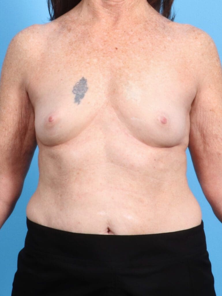 Breast Augmentation - Case 24648 - Before