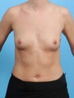 Breast Augmentation - Case 24683 - Before