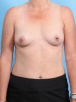 Breast Augmentation - Case 24702 - Before