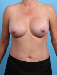 Breast Augmentation - Case 24702 - After