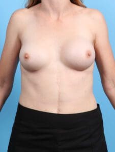 Breast Implant Revision - Case 24710 - Before