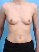 Breast Augmentation - Case 24782 - Before