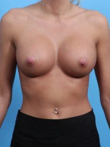 Breast Augmentation - Case 24782 - After