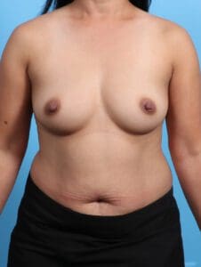 Breast Augmentation - Case 24897 - Before