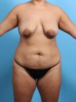 Breast Lift/Reduction with Implants - Case 24905 - Before