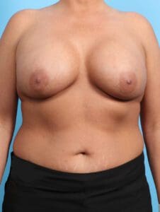 Breast Lift/Reduction with Implants - Case 24925 - Before