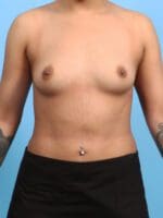 Breast Augmentation - Case 25019 - Before
