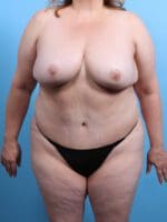 After Weight Loss - Case 25043 - After
