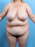After Weight Loss - Case 25043 - Before