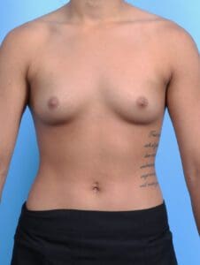 Breast Augmentation - Case 25059 - Before