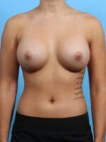 Breast Augmentation - Case 25059 - After