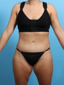 Tummy Tuck - Case 25149 - After
