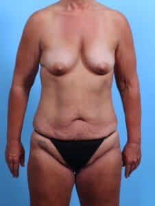 After Weight Loss - Case 25157 - Before