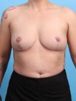 Breast Implant Removal - Case 25167 - After
