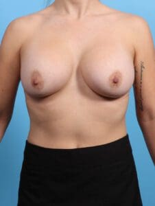 Breast Augmentation - Case 25185 - After