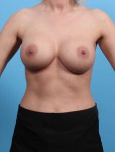 Breast Augmentation - Case 25296 - After