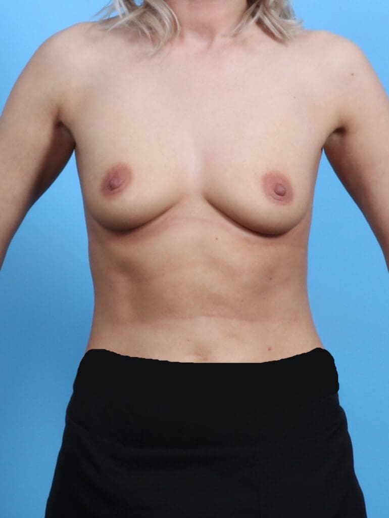 Breast Augmentation - Case 25296 - Before