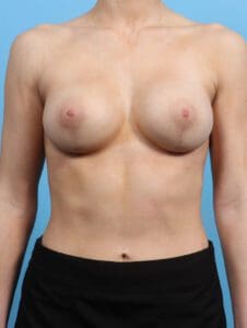 Breast Lift/Reduction with Implants - Case 25352 - After