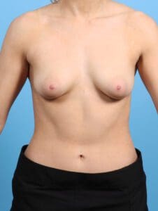 Breast Lift/Reduction with Implants - Case 25352 - Before