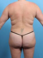 Liposuction - Case 25405 - After