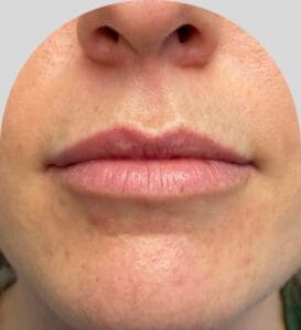Lip Fillers - Case 25419 - Before