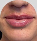 Lip Fillers - Case 25427 - After