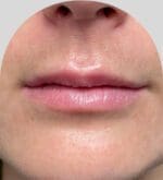 Lip Fillers - Case 25431 - Before
