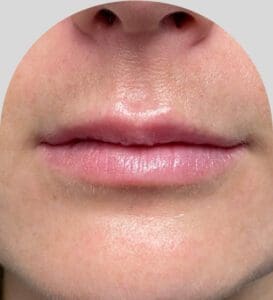 Lip Fillers - Case 25431 - Before