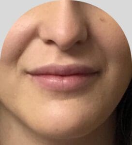 Lip Fillers - Case 25435 - Before