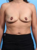 Breast Augmentation - Case 25520 - Before