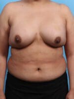 Breast Augmentation - Case 25536 - After