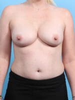 Breast Implant Revision - Case 25561 - Before