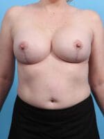 Breast Implant Revision - Case 25561 - After