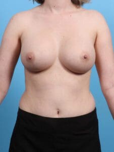 Breast Augmentation - Case 25569 - After