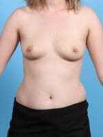 Breast Augmentation - Case 25569 - Before