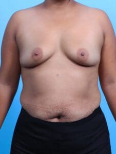 Breast Augmentation - Case 25650 - Before